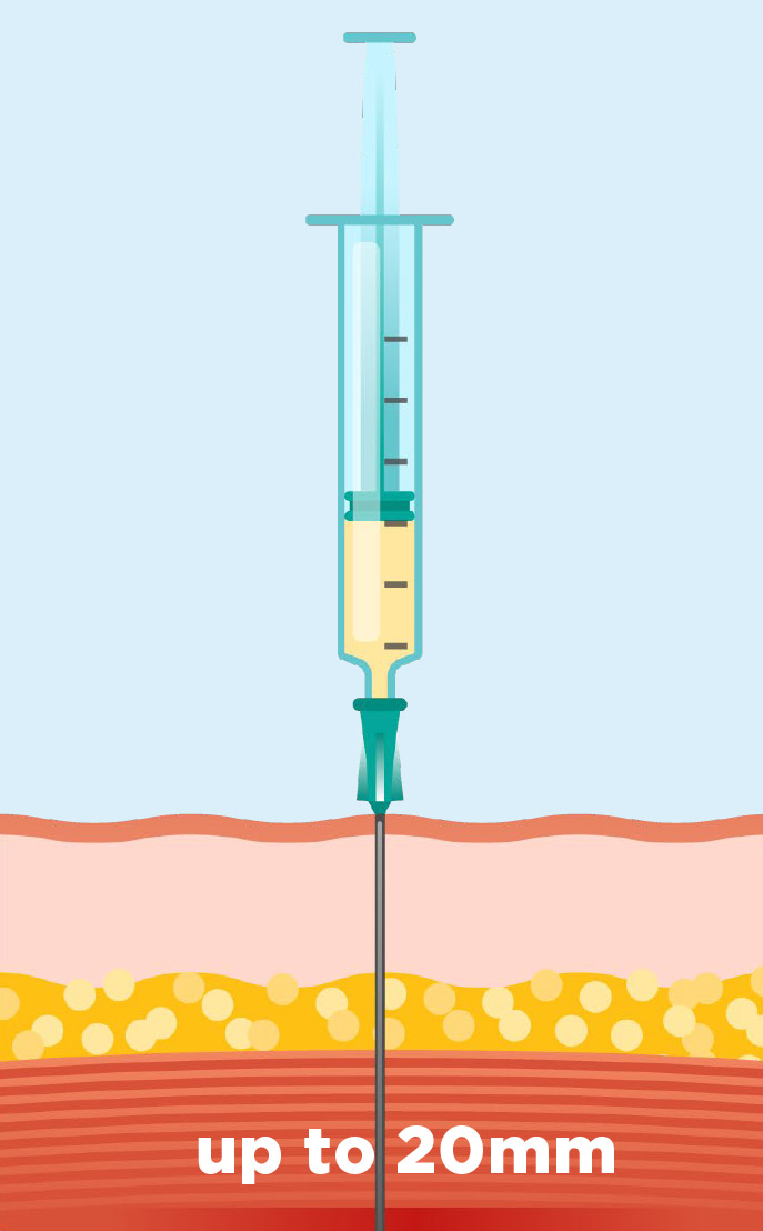 The Science of the Micro-Needle | PKA SoftTouch Corp.